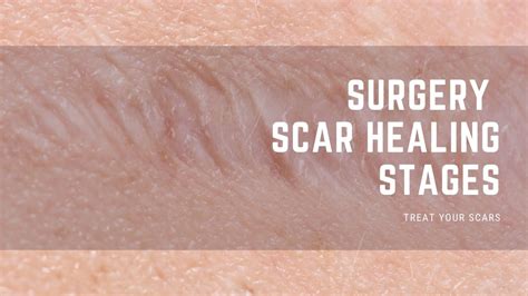 Surgery Scar Healing Stages - Treat Your Scars