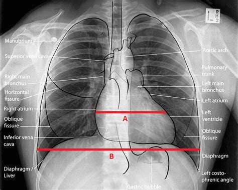 Cardiomegaly X Ray - tacitceiyrs