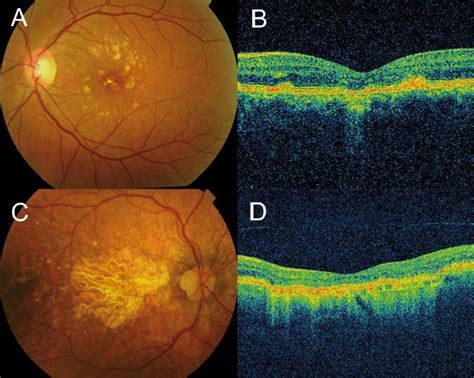 Macular Dystrophy Retina