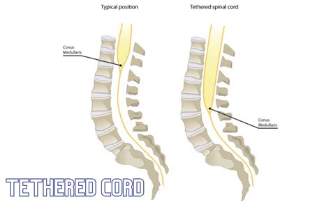 Tethered Spinal Cord Syndrome - IRAN Health Tourism Organizer - Iran ...