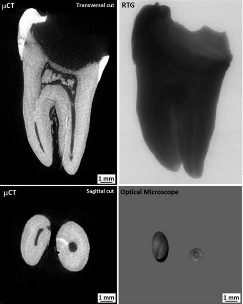 The images of canal system of first mandibular molar observed by X-ray... | Download Scientific ...