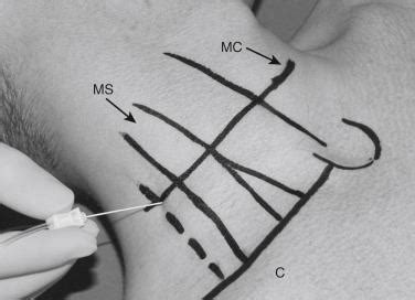 Interscalene Nerve Block: Potential Severe Complications - Clinical Tree