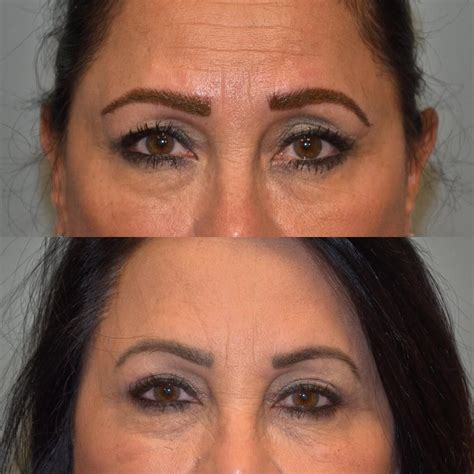 A little Botox and an upper blepharoplasty. All performed in office ...