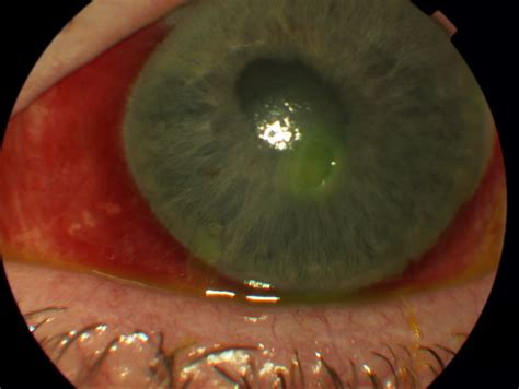 Corneal Laceration Vs Abrasion