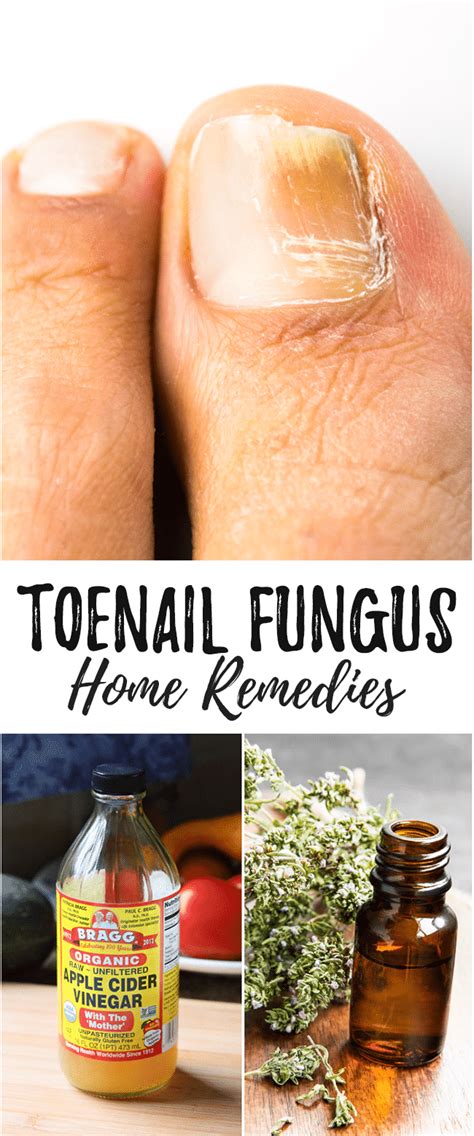 Toenail Fungus Cures That Really Work | Toenail fungus home remedies, Toenail fungus remedies ...