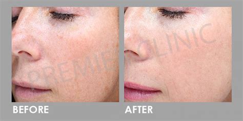 Large Pores Tightening with Carbon Peel Laser | Premier Clinic