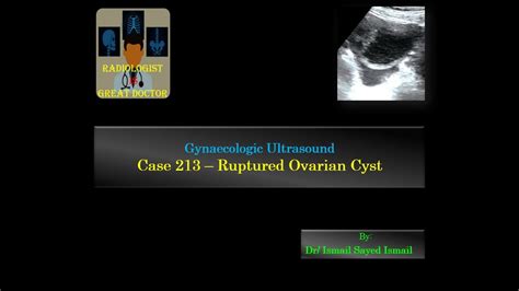 Ruptured Ovarian Cyst Ultrasound