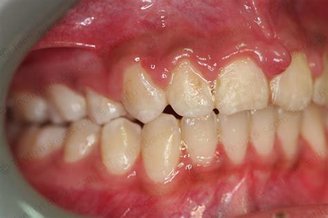 Case 28: Severely protruded upper teeth | Teeth N Braces