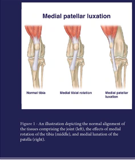 Figure 1 from Luxation of the patella. | Semantic Scholar