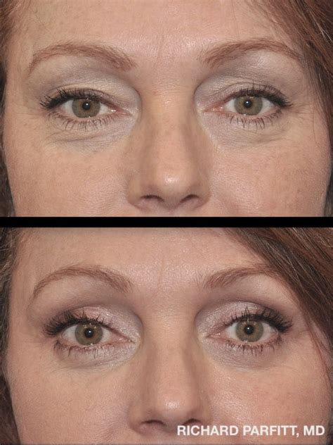 Eyelid Surgery before and after photos