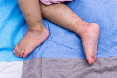 Hand, Foot, And Mouth Disease In Babies: Causes, Symptoms And Home Remedies