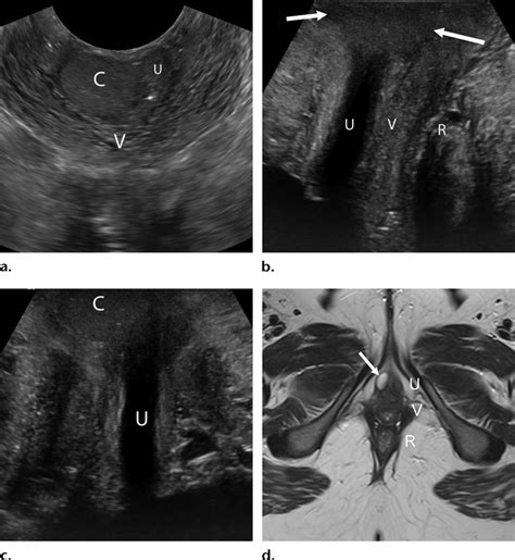 Skene gland cyst in a 41-year-old woman who presented with pelvic pain.... | Download Scientific ...