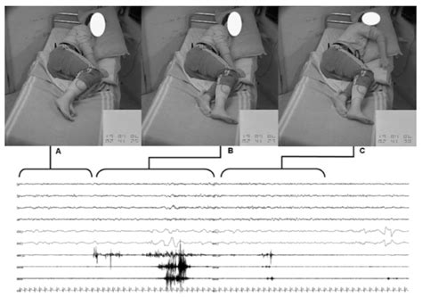 "Nocturnal video-polysomnography (PSG) documenting an RBD episode. (A)... | Download Scientific ...