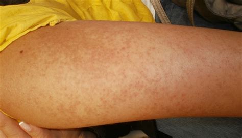 Clinical Challenge: Asymptomatic Dermatitis That Feels Like Sandpaper - MPR