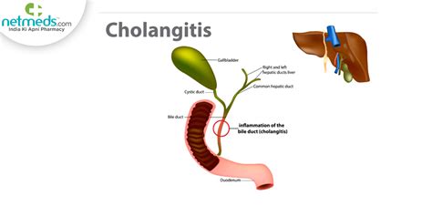 Primary Biliary Cholangitis: What It Is, Symptoms,, 55% OFF