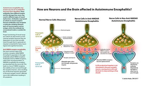 How is the Brain Affected in Autoimmune Encephalitis? - Jackie Heda ...