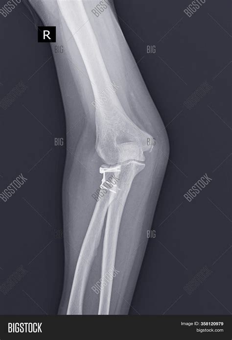 X-ray Elbow Joint. Image & Photo (Free Trial) | Bigstock