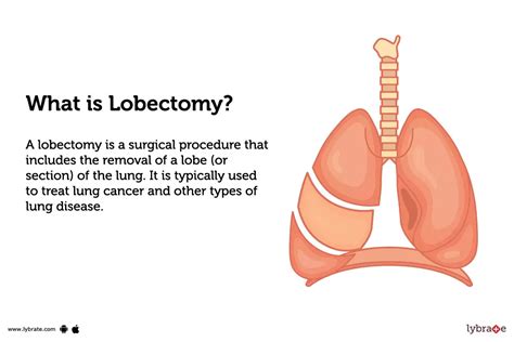 Lobectomy: Causes, Symptoms, Treatment and Cost