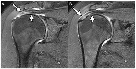 Supraspinatus Tear Mri