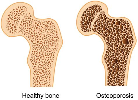 Bone Density - Causes And Other Risk Factors Related