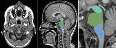 Frontiers | Improving Accuracy of Brainstem MRI Volumetry: Effects of Age and Sex, and ...