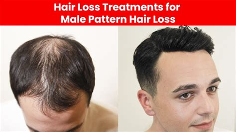 Hair Loss Treatment for Men in Male Pattern Baldness | Hair Loss ...