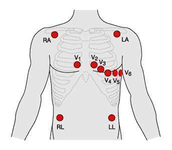 12 Lead ECG Placement | NCLEX Prep and Study Resource | Pinterest | Medical, School and Nclex