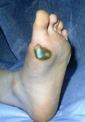 Blackening of skin due to gangrene on foot - Stock Image - M165/0182 - Science Photo Library