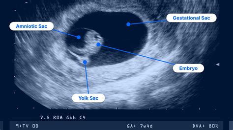 Early Pregnancy Ultrasound: What to Expect From Your First Scan