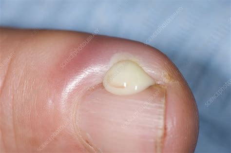 Paronychia infection of the finger - Stock Image C009/0030 - Science Photo Library