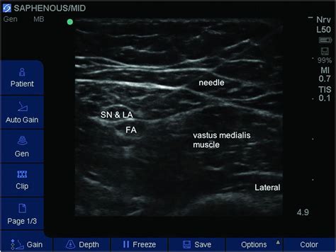 Ultrasound-guided saphenous nerve block | Anesthesia Key