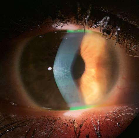 Keratoconus with corneal scarring : r/optometry