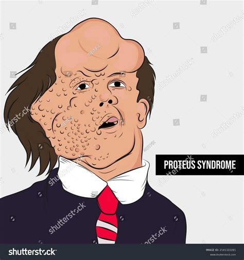 Proteus Syndrome Congenital Disease That Causes Stock Vector (Royalty ...