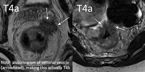 MRI Rectal Cancer Staging - RAD-ASSIST