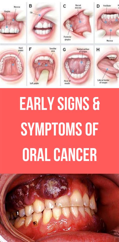 Early Signs & Symptoms of Oral Cancer - health news