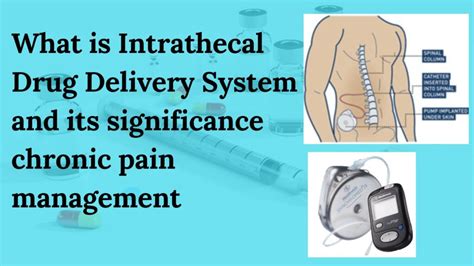 WHAT IS INTERATHECAL DRUG DELIVERY SYSTEM AND IT’S SIGNIFICANCE CHRONIC PAIN MANAGEMENT – MEC ...