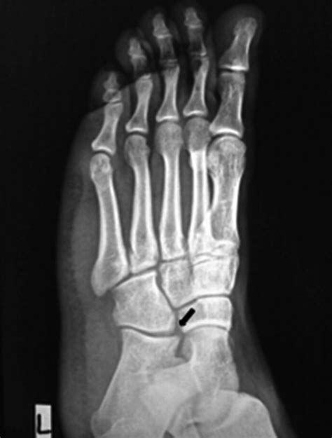 Os calcaneus secundarius mimicking fracture | BMJ Case Reports