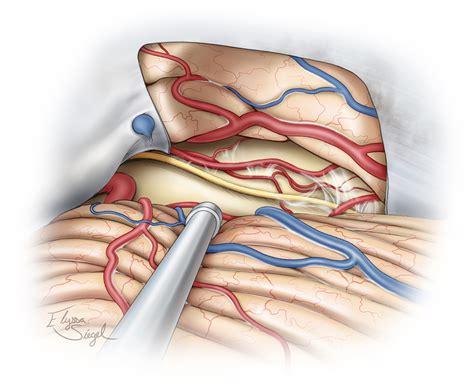 Petrous Apex Meningioma | The Neurosurgical Atlas, by Aaron Cohen-Gadol, M.D.