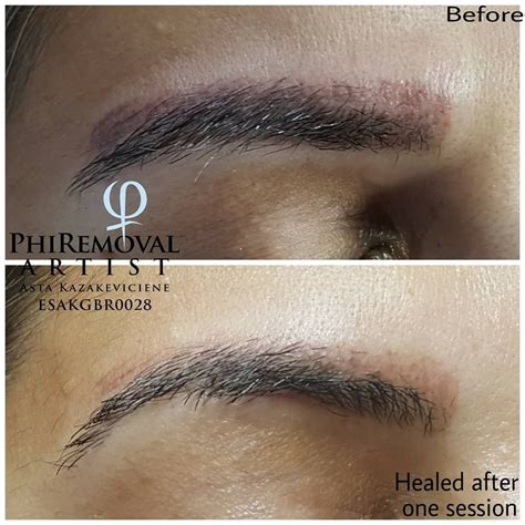 Eyebrows Removal procedure | Laser tattoo removal, Eyebrow tattoo ...