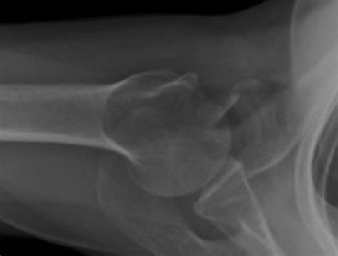 Axillary shoulder X-ray demonstrating a displaced fracture of the... | Download Scientific Diagram