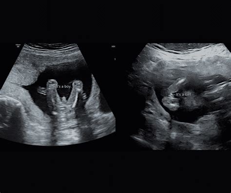 Our Well-being & Gender Scan Explained - Window to the Womb