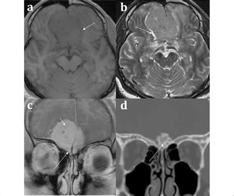 Olfactory groove meningioma. 51-year-old male presenting with headache.... | Download Scientific ...