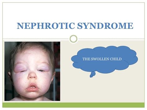 8. Nephrotic Syndrome & AcuteGlomerularNephritis