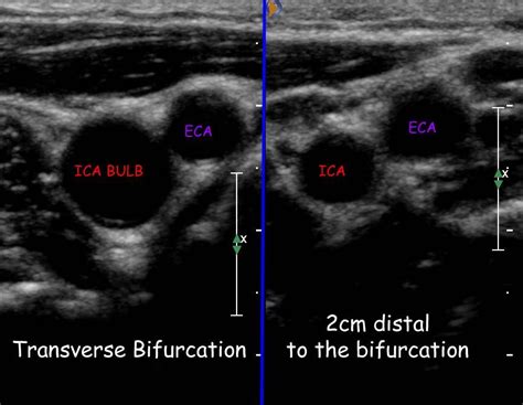 transverse carotid bifurcation | anatomy | Pinterest | Ultrasound