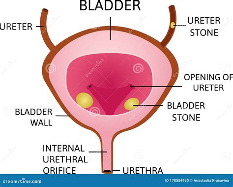 Bladder Stones Cartoon Poster Vector Illustration | CartoonDealer.com ...