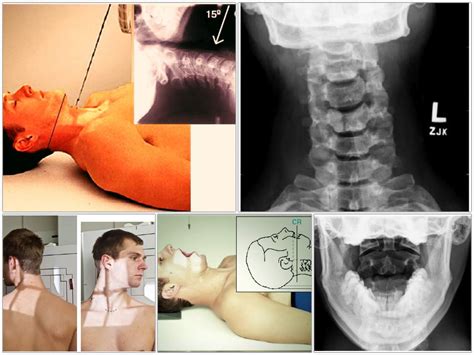 Cervical spine with right tilt x ray - areamens