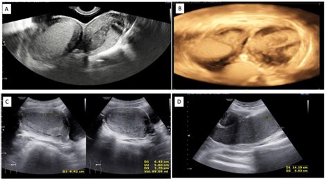 Ultrasound Images of (A) Images of bicorporeal uterus with hematometra ...