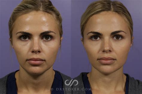 Cheek Filler Case #1618