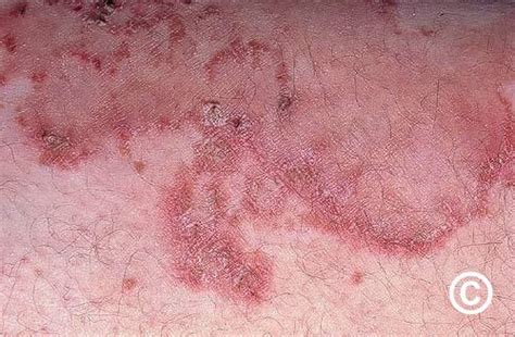 Necrolytic migratory erythema