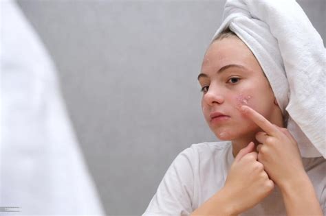 Acne Excoriée: Causes, Symptoms, and Available Treatment